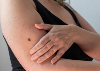Melanoma: los datos que hay que conocer sobre el cáncer de piel más agresivo