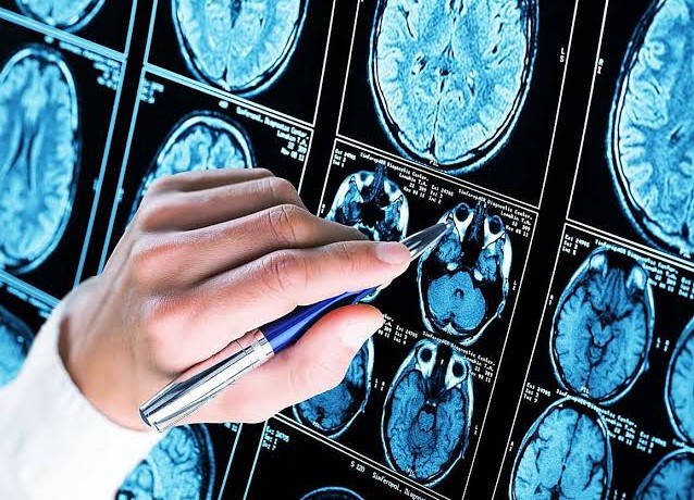 Un paciente en Reino Unido es el primero en el mundo operado del cerebro con apoyo de inteligencia artificial en tiempo real