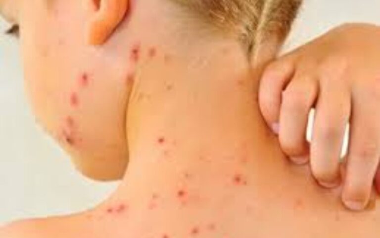 OPS emite una alerta epidemiológica para incrementar la vacunación ante el brote de sarampión en América
